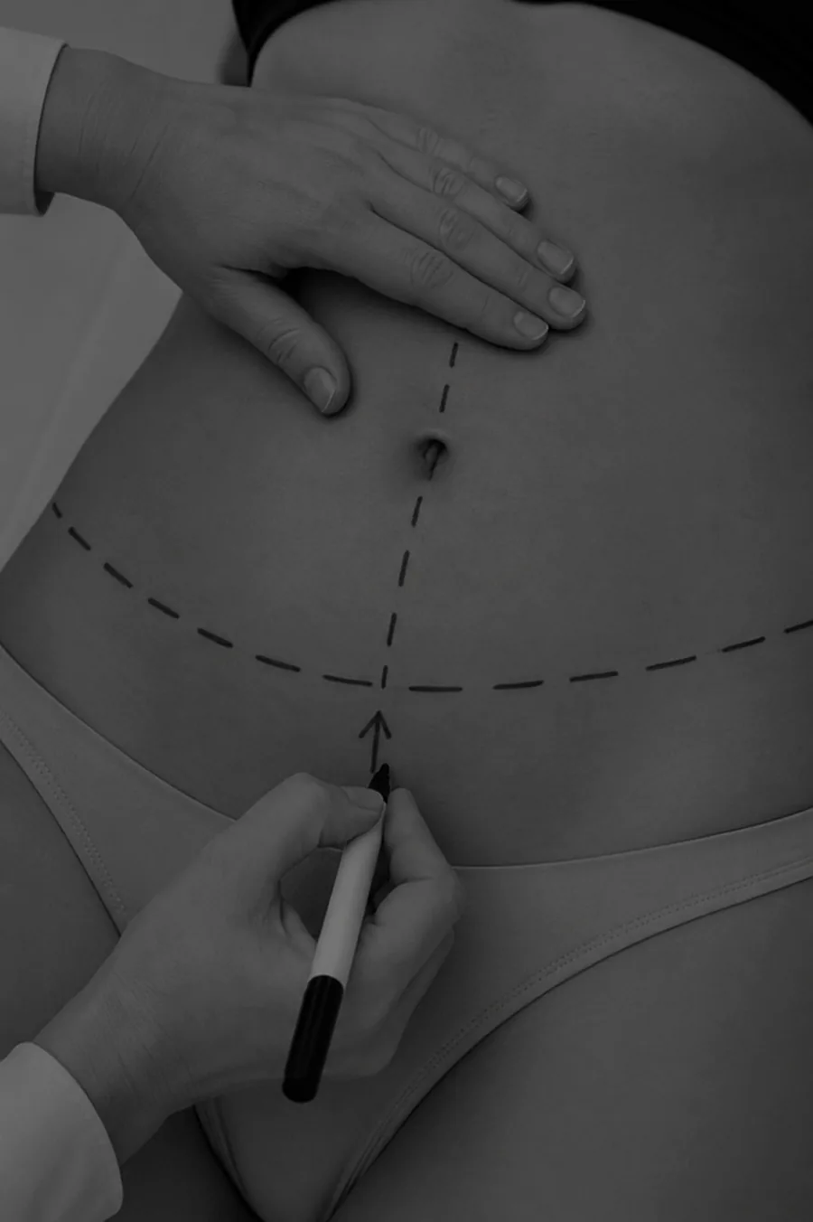 Abdominoplasty (Tummy Tuck)