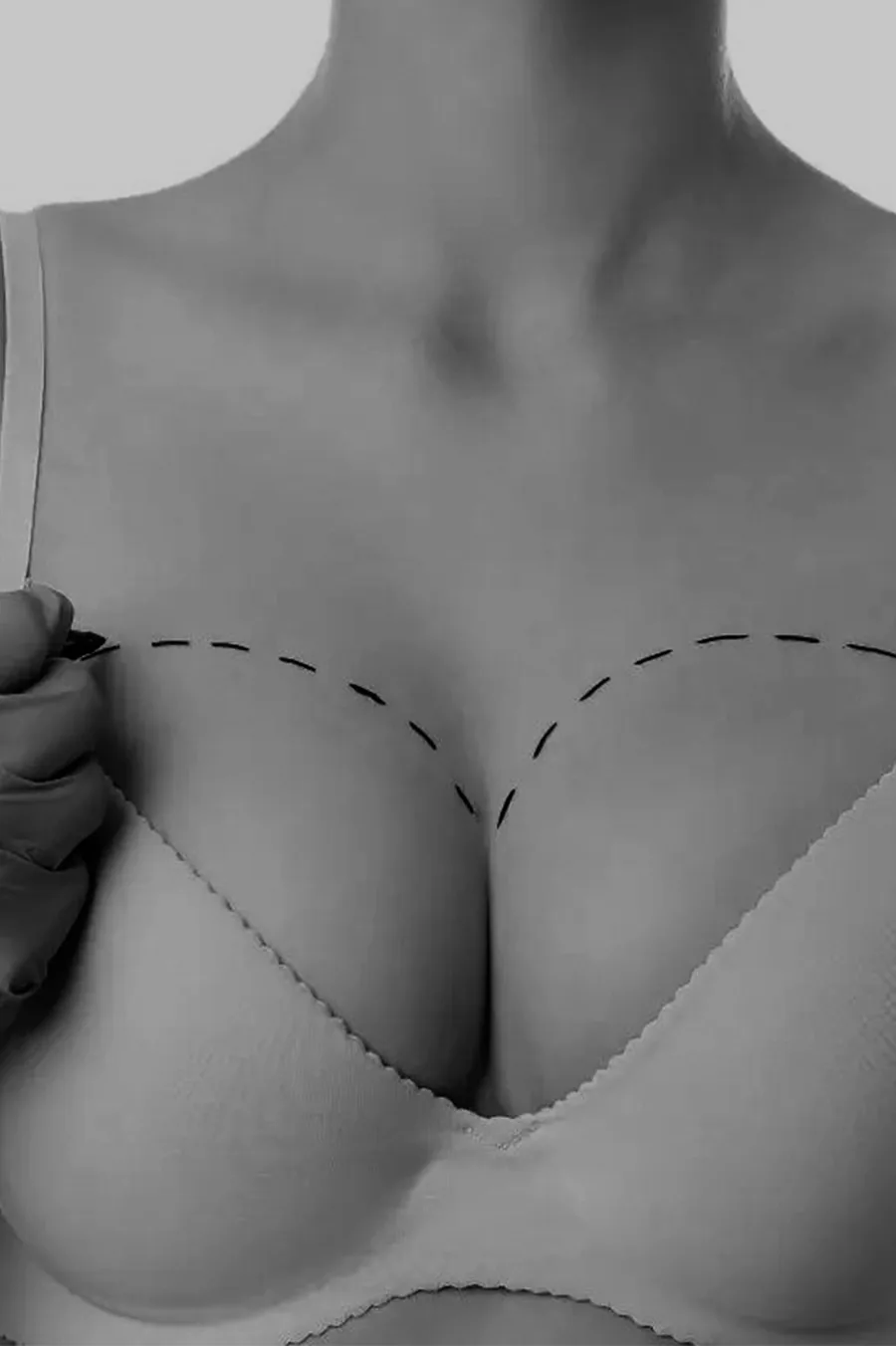 Breast Augmentation