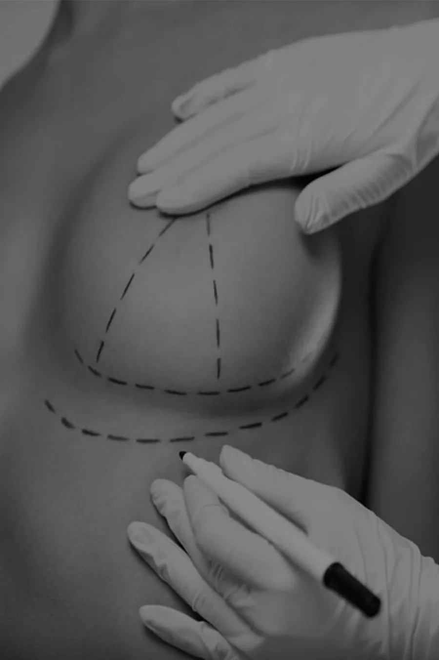 Breast Lift (Mastopexy)