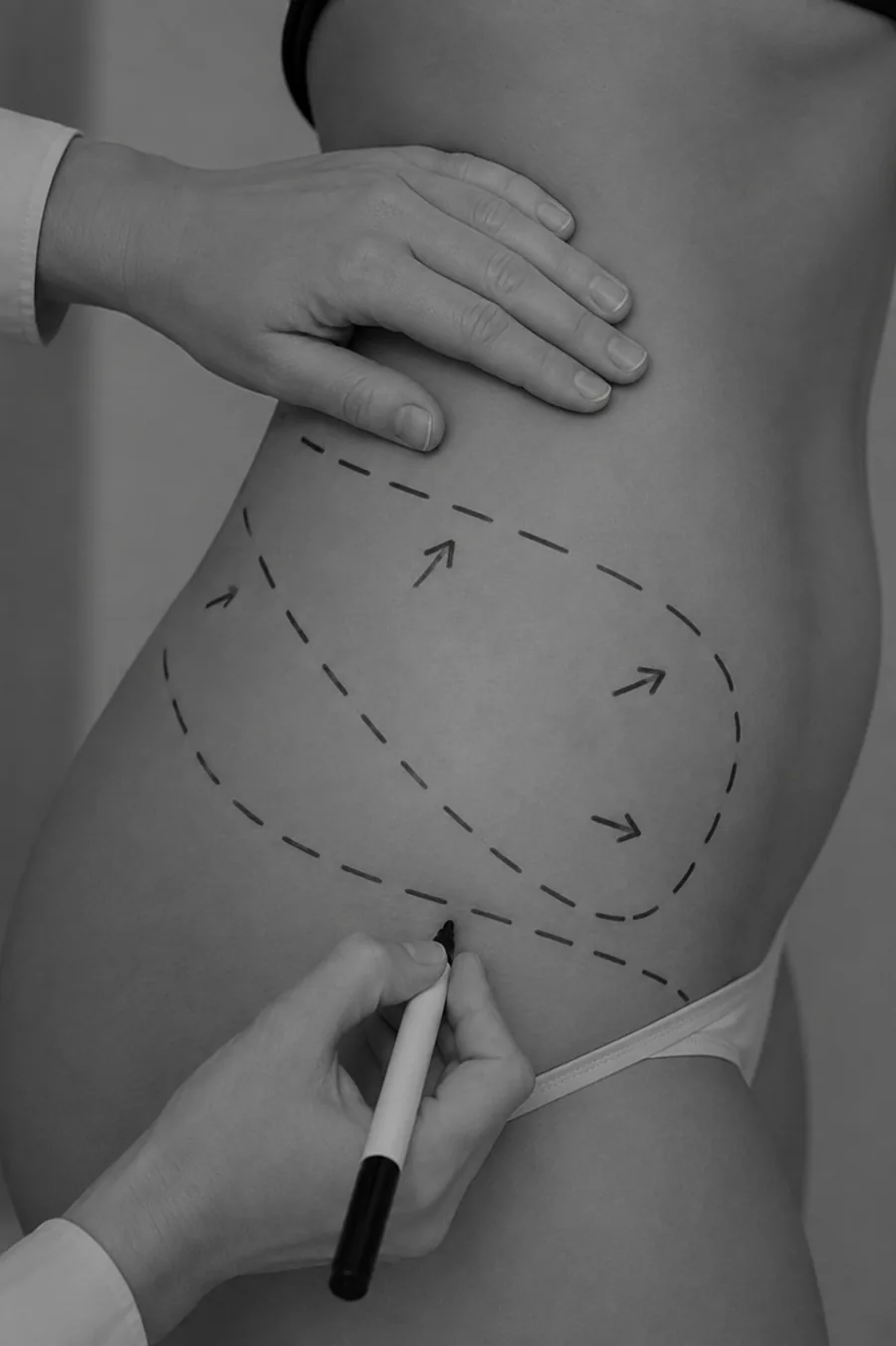 Liposuction