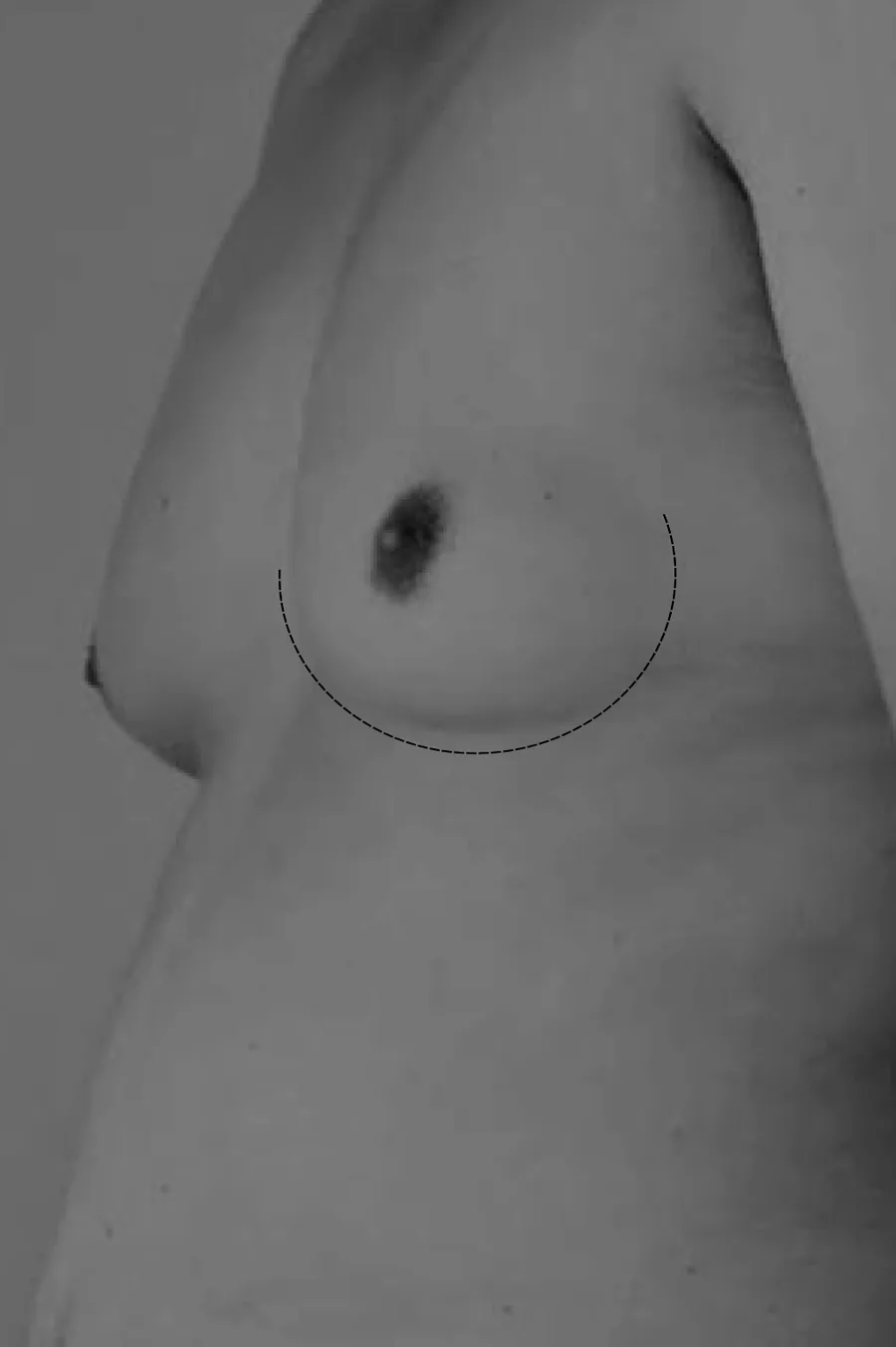 Male Breast (Gynaecomastia)