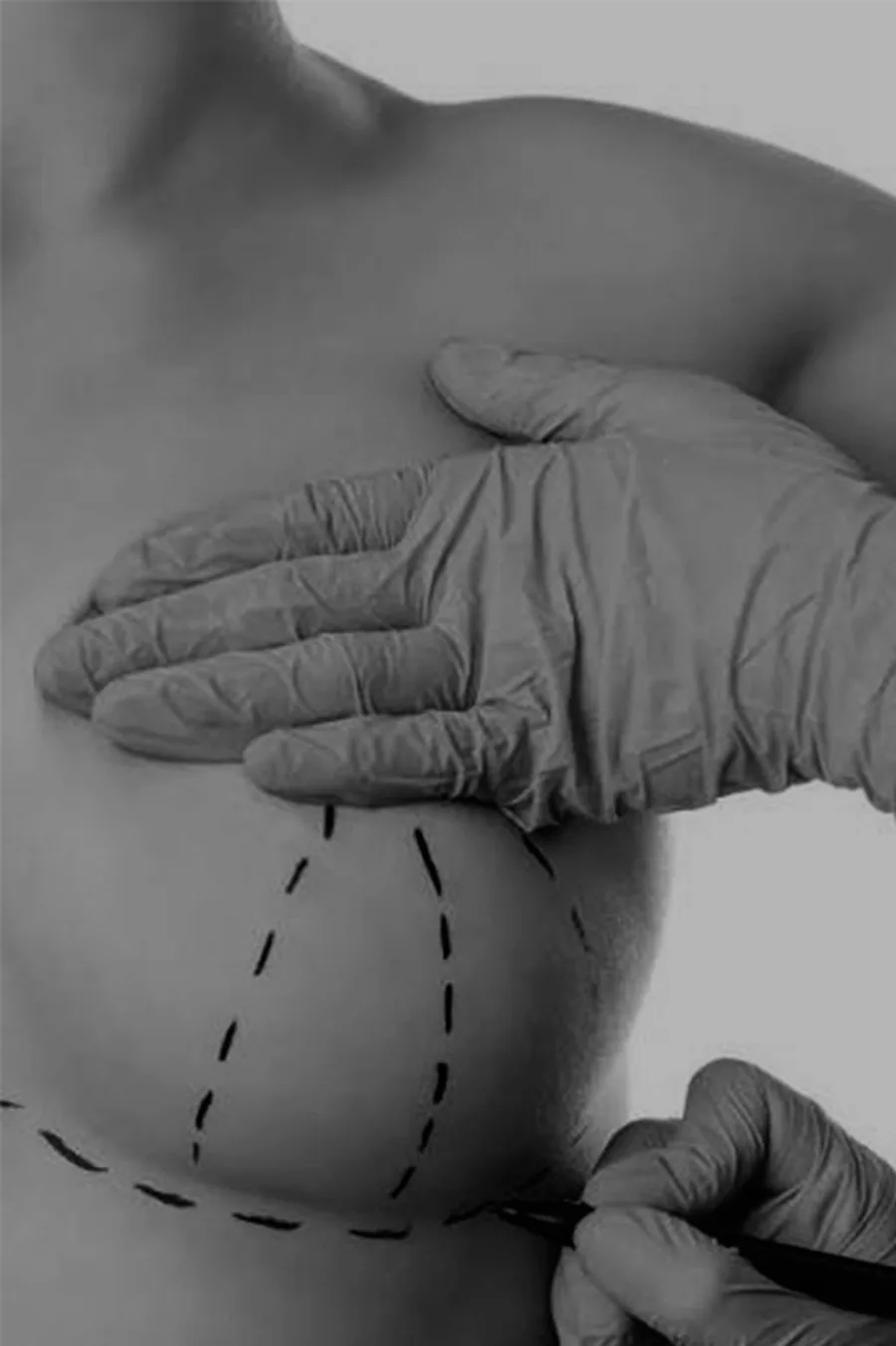 Breast Reduction
